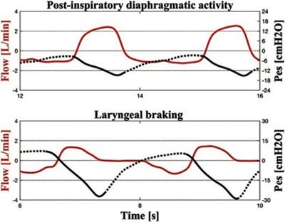 Expiratory braking defines the breathing patterns of asphyxiated neonates during therapeutic hypothermia